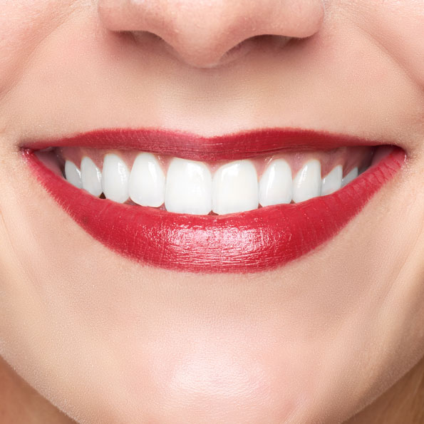 Bleaching & Ästhetik